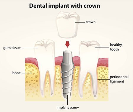 Dental Implant